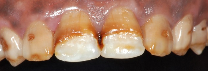 Severely decayed teeth