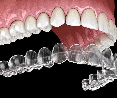computer model of Invisalign aligners fitting over teeth