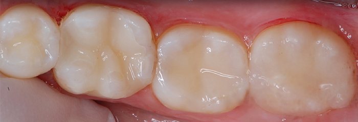 Teeth with tooth-colored fillings