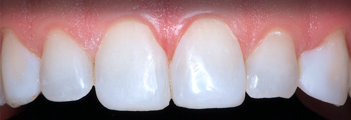 Closed gaps between front teeth