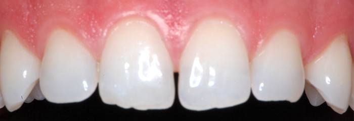 Gaps between front teeth