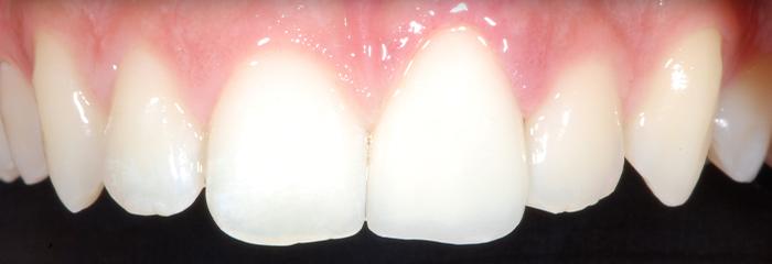 Repaired front tooth