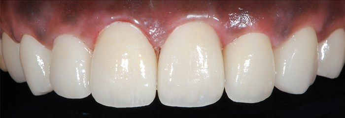 Repaired teeth