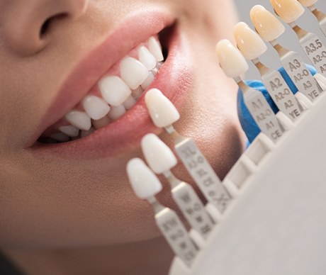 Smile compared with tooth color chart