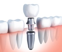 Animation of implant supported dental crown