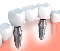 Animation of implant supported dental crown