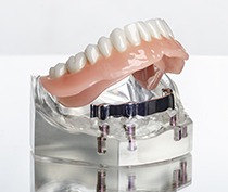 Model implant supported denture