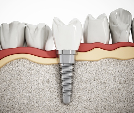 Animation of implant supported dental crown