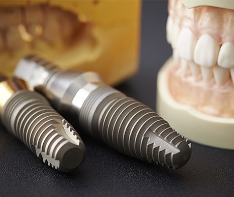Dental implant posts next to model smile