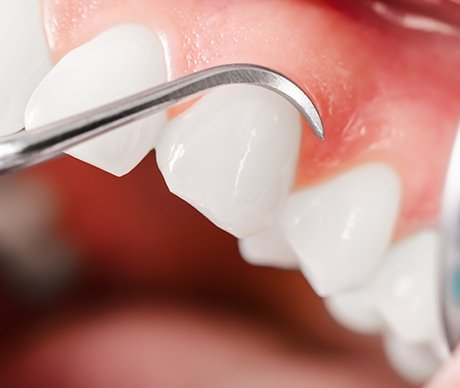 Closeup of smile during gum treatment