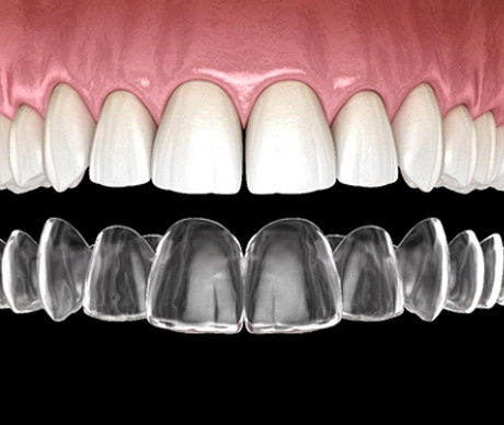 Illustration of clear aligner being placed on teeth