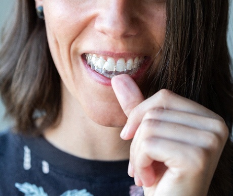 Close-up of woman sliding clear aligner onto her teeth