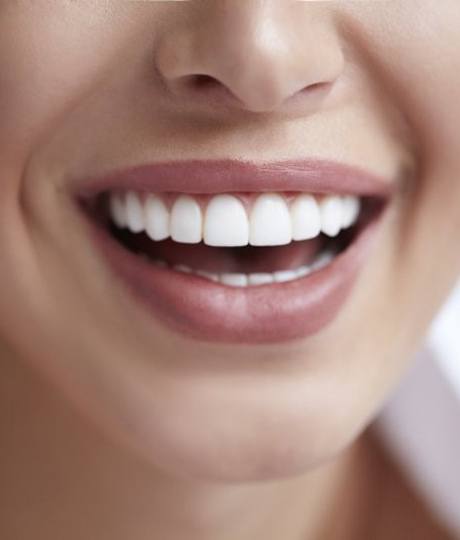 close up person smiling with veneers in Vienna