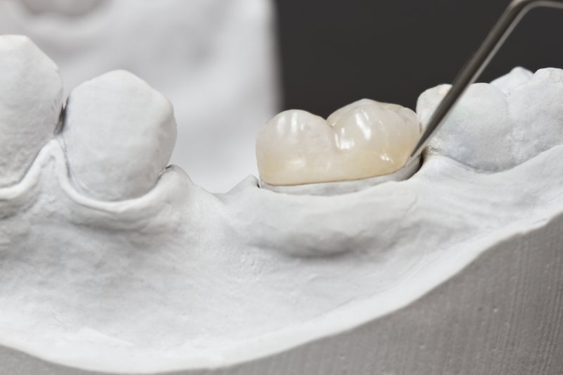 a mouth mold with a single dental crown