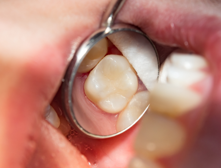 Close up of dental filling on molar